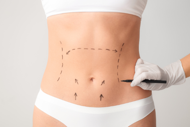 abdominoplastia lanzarote