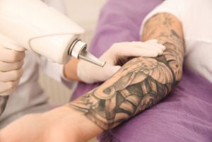 láser para borrar tatuajes